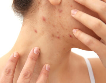 Adults & Acne: An Adult Affliction testochecker adult pimples